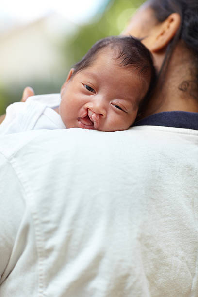 Safe in her mother's arms Portrait of a baby girl who has a cleft palate looking over the shoulder of her mother cleft lip stock pictures, royalty-free photos & images