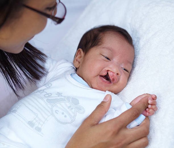 Showing her strong grip A baby with a cleft palate holding her mother's finger and smiling cleft lip stock pictures, royalty-free photos & images