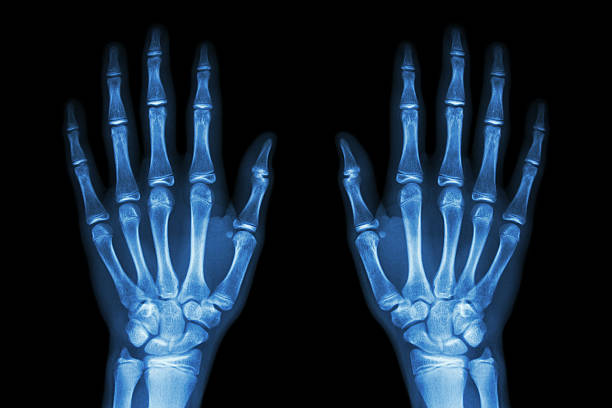 x-ray normalen menschliche hände (vorne), auf schwarzem hintergrund - x ray x ray image human hand anatomy stock-fotos und bilder