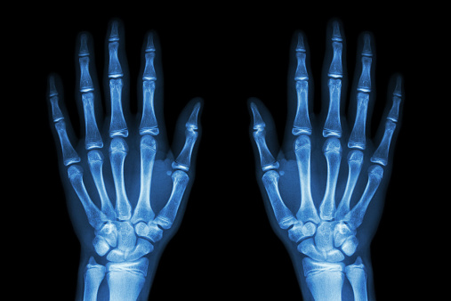 X-ray manos humanas normales (delantero) sobre fondo negro photo
