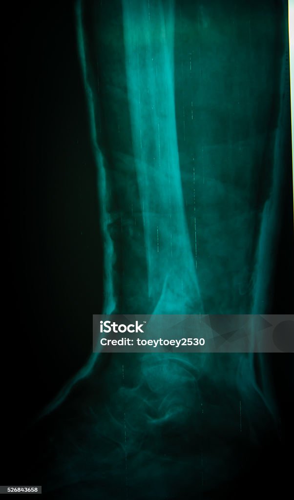 X-ray of the leg Adult Stock Photo