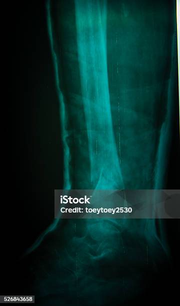 Xray Of The Leg Stock Photo - Download Image Now - Adult, Anatomy, Blue