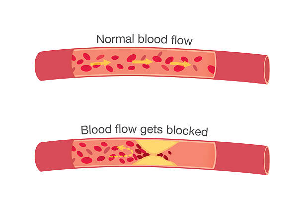 ilustraciones, imágenes clip art, dibujos animados e iconos de stock de normales de las etapas de flujo de la sangre y bloqueo de fase - healthcare and medicine human cardiovascular system anatomy human blood vessel