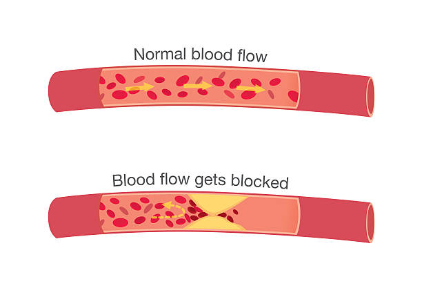 Normal stages of blood flow and blocked stages Blood flow in atherosclerosis in normal stages and when get blocked by fatty which that is cause angina and heart attack. colesterol stock illustrations