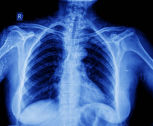 istock X-ray of chest 527190619