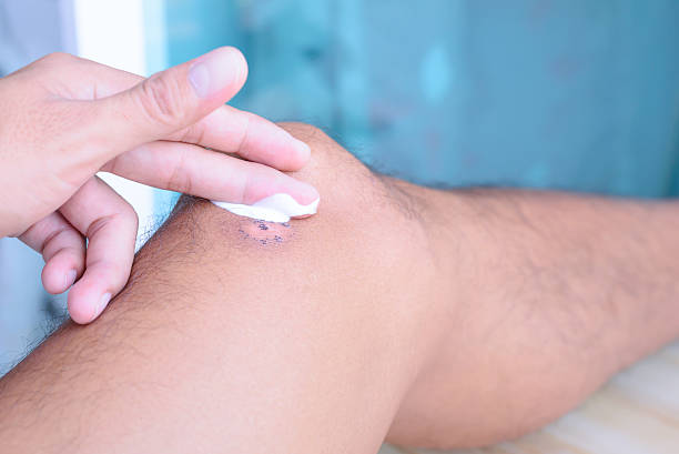 istock Treatment for scar on leg. 527217312