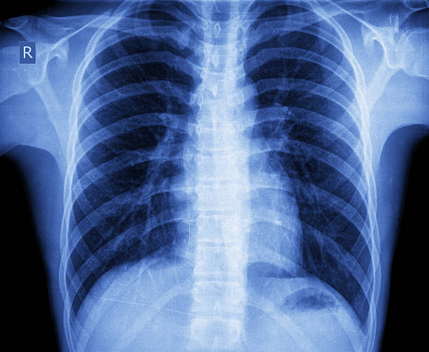 istock X-ray of chest 527311959