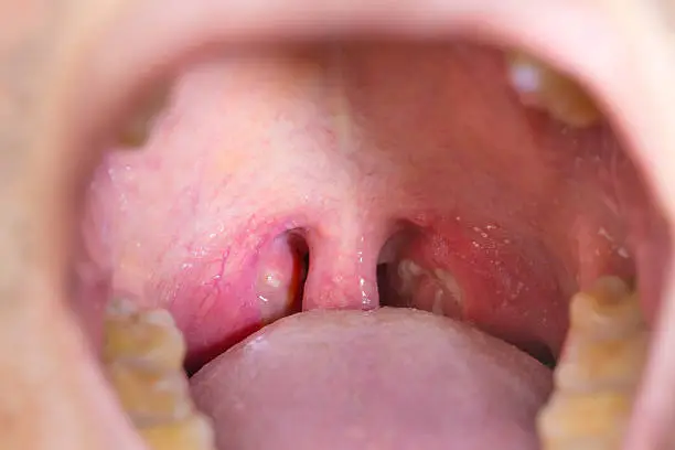 Photo of tonsil throat