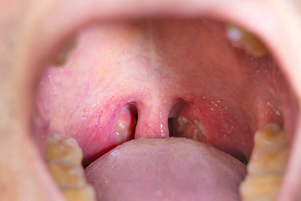 amígdala garganta - tonsillitis - fotografias e filmes do acervo