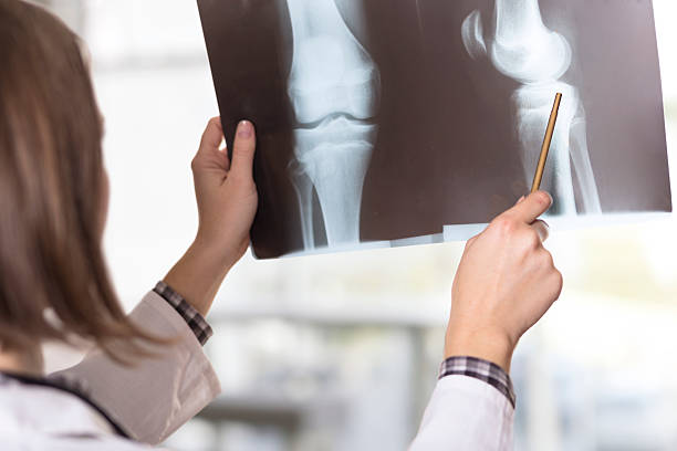 X-ray scan Young female doctor looking at the x-ray picture of knee injury in a hospital standing had to knee pose stock pictures, royalty-free photos & images