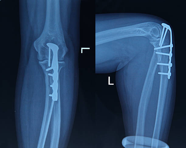 imagerie par rayons x des pieds - x ray human knee orthopedic equipment human bone photos et images de collection