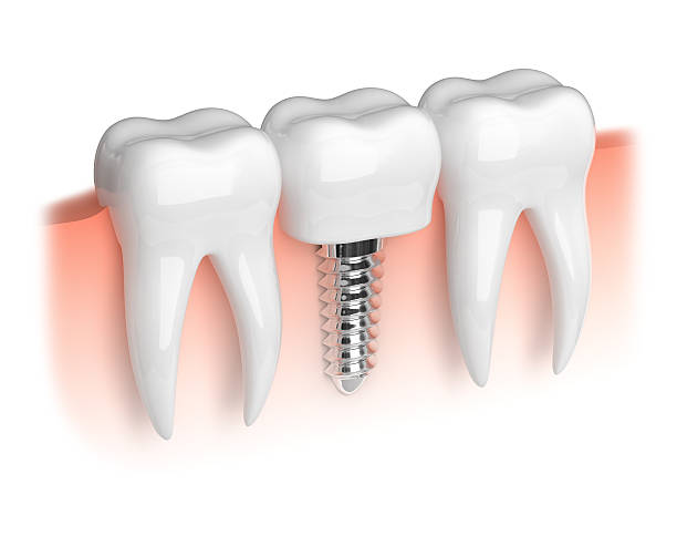 Model of teeth and dental implant stock photo