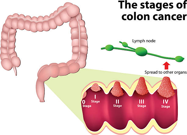 The Stages of Colorectal Cancer Colorectal Cancer. Stage of development of a malignant tumor (0 to 4). the system that is most commonly used for the staging process of colon cancer colon cancer screening stock illustrations