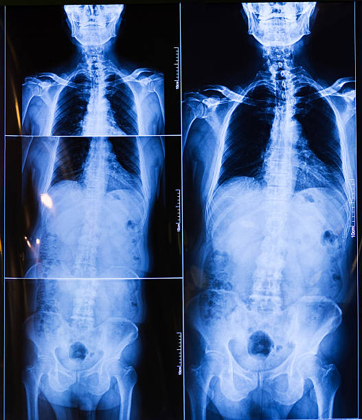 胴体 x 線 - orthopedic equipment osteoporosis x ray human spine ストックフォトと画像