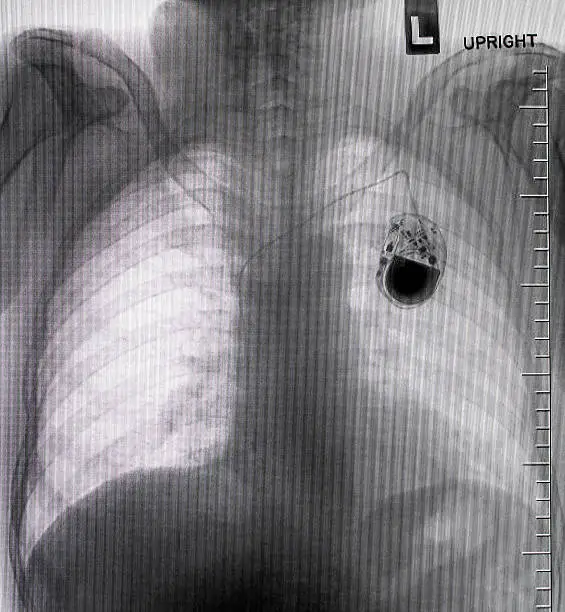 chest with the pacemaker on x-ray film