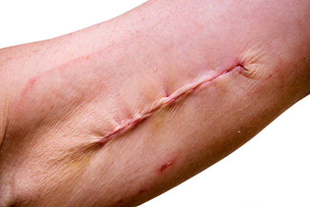 Arm surgery A wound on a senior woman’s upper arm, from which tissue was harvested a week earlier to fill a depression in the forehead resulting from a previous craniotomy. Internal stitches were used to close the incision and the wound was covered by a large dressing, the removal of which has left red marks and dry skin. It was all extremely painful! scab arm stock pictures, royalty-free photos & images