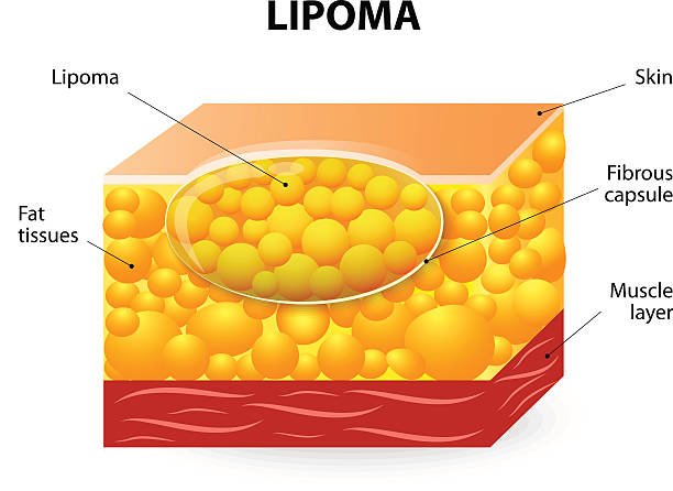 ilustraciones, imágenes clip art, dibujos animados e iconos de stock de lipoma - human tissue histology dermatology human skin