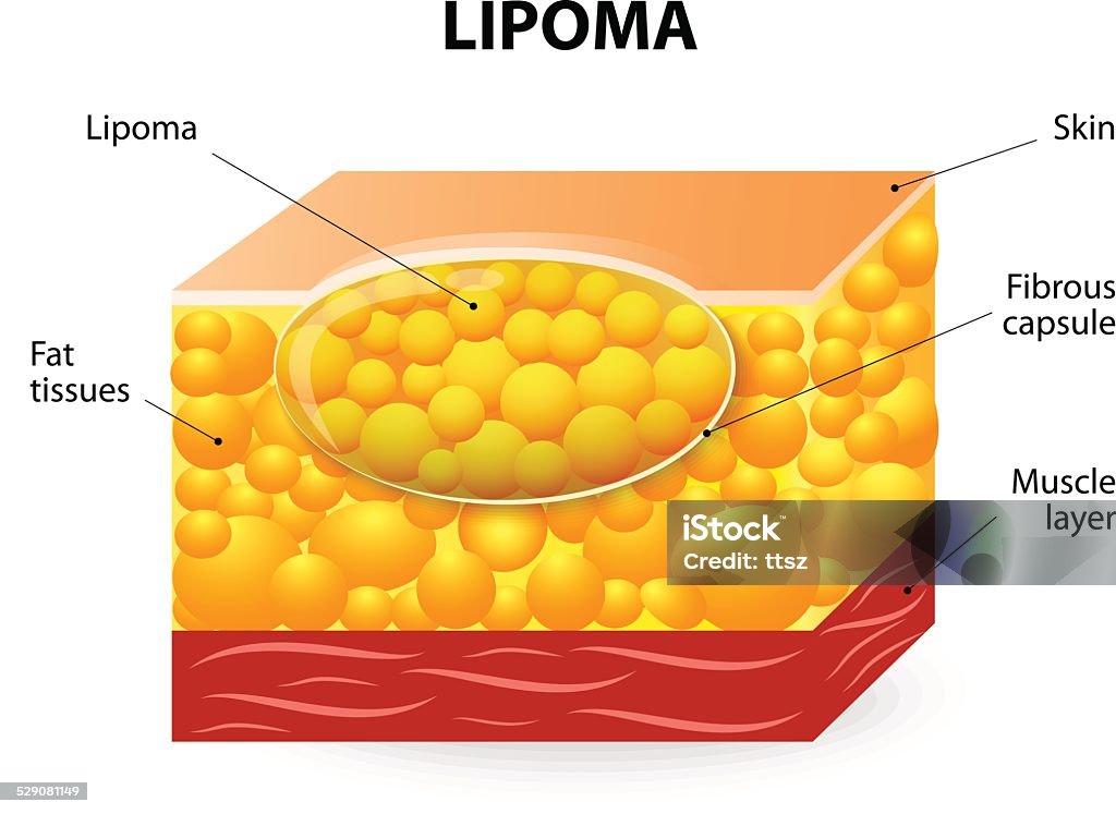 lipoma Lipoma are adipose tumors located in the subcutaneous tissues. Lipoma stock vector