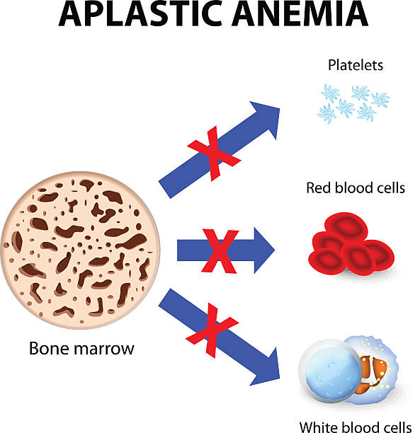 aplastic anemia aplastic anemia. disease bone marrow anemia diagram stock illustrations