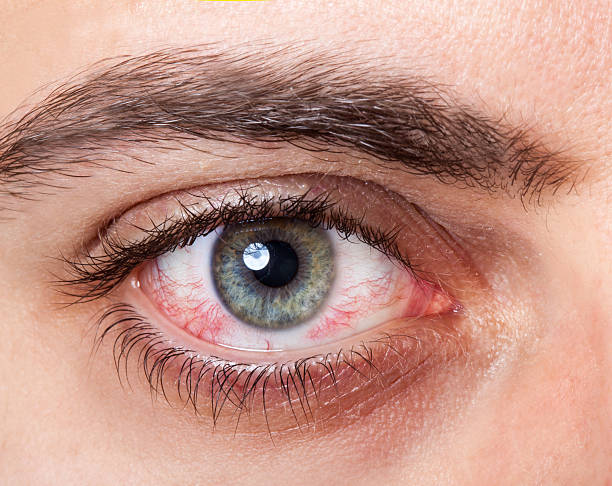 istock Irritated red bloodshot eye 529278093
