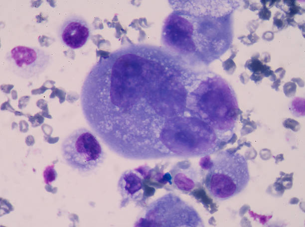 istock Cancer Cell in human showing abnormal cells. 529407568