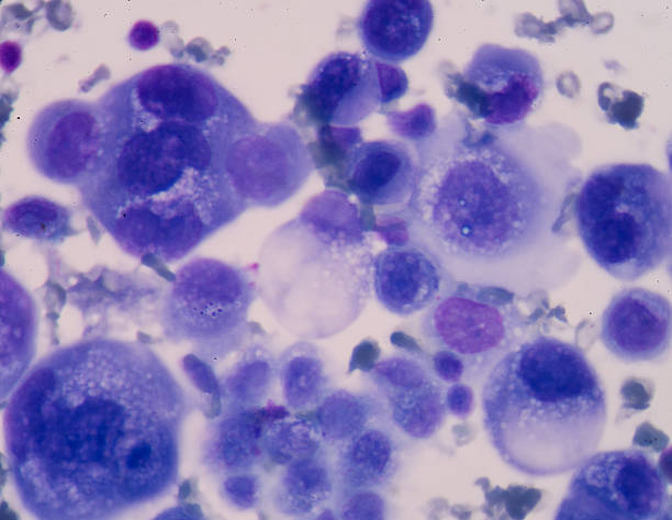 istock Cancer Cell in human showing abnormal cells. 529407626