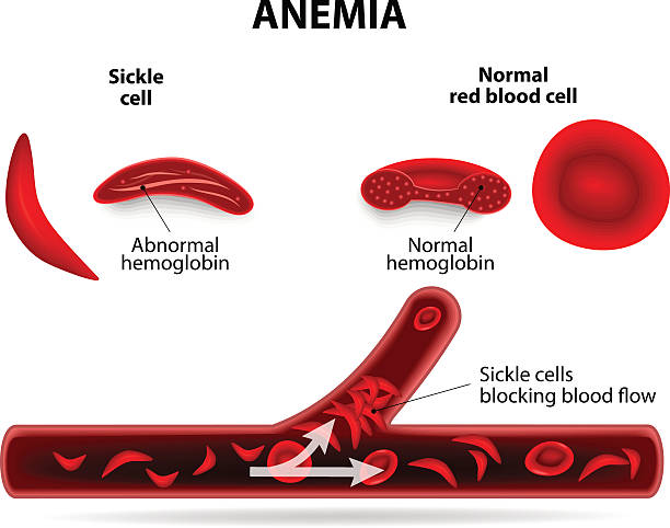 anemia anemia. sickle cell and normal red blood cell anemia diagram stock illustrations