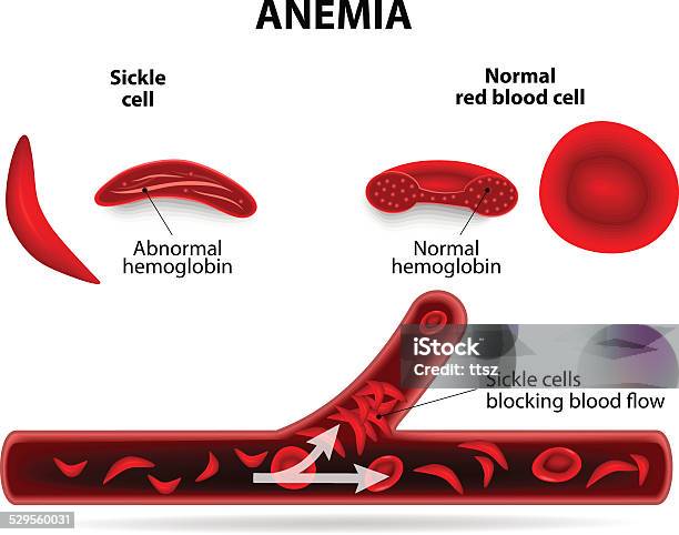 Anemia Stock Illustration - Download Image Now - Sickle Cell Anemia, Anemia, Red Blood Cell