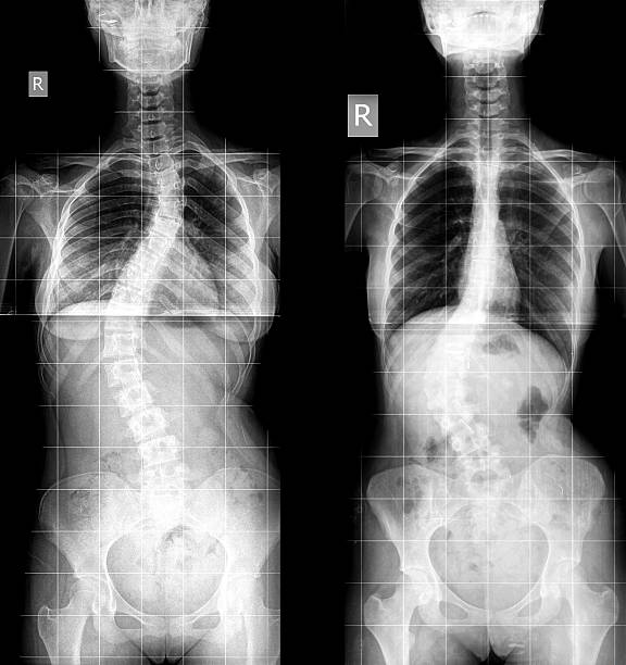 istock Scoliosis X-ray image 529561445
