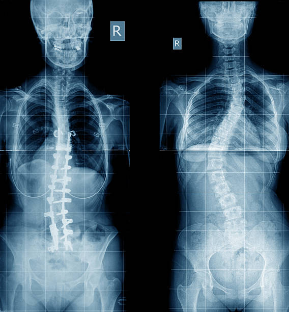 脊柱側弯症 x 線画像、インプラント - scoliosis ストックフォトと画像