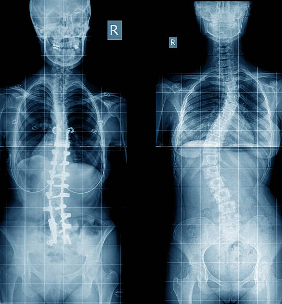 척추측만증 x-선 이미지 삽입 - human lung x ray image x ray human spine 뉴스 사진 이미지