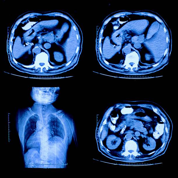 コレクションの x 線を複数の部品を伴う - pain rib cage x ray image chest ストックフォトと画像