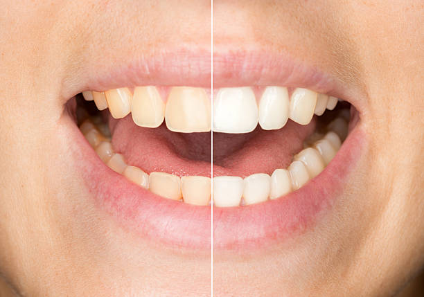 istock Dental Care, Teeth before and after Whitening / Bleaching 529692783
