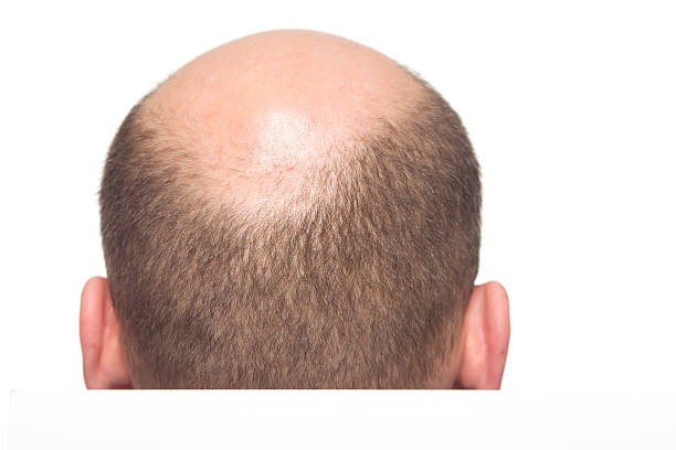 男性の xxxl baldness - bald patch ストックフォトと画像