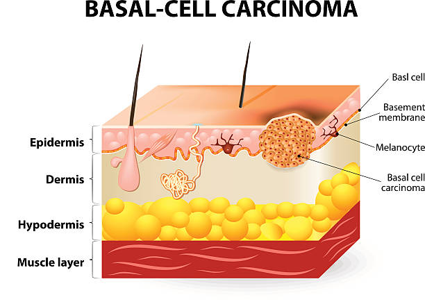 심저-세포 암종 또는 바닥세포 게자리 - 기저세포암종 stock illustrations