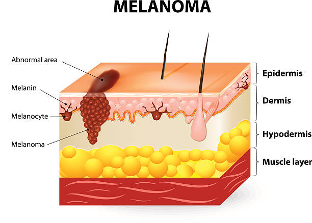 Melanoma or skin cancer Melanoma or skin cancer. This rare type of skin cancer originates from melanocytes. layers of the human skin. melanoma stock illustrations