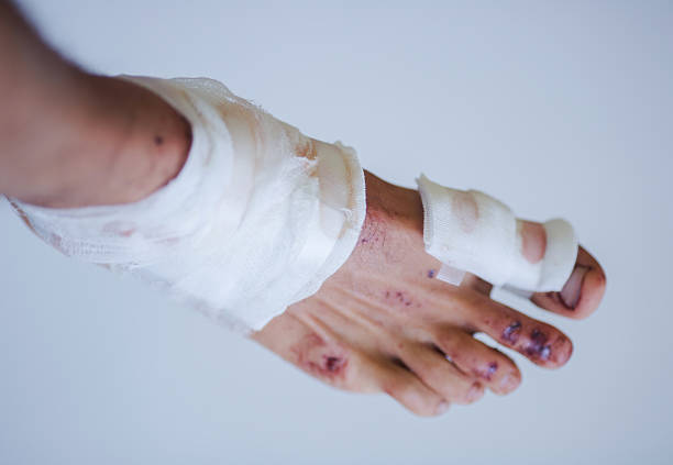 foot injury bloody foot bandaged after an accident slow healing wounds stock pictures, royalty-free photos & images