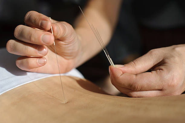 istock Acupuncture.Chinese medicine treatmen 530258371