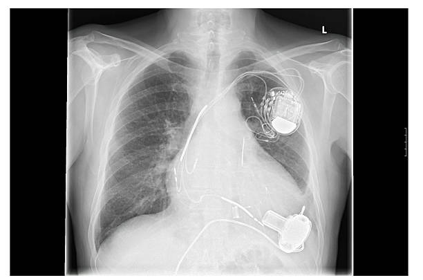 x-ray image, links, künstliches herz herzschrittmacher - herzschrittmacher stock-fotos und bilder