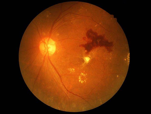 retina of diabetic-diabetici retinophaty - retinopatia diabetica foto e immagini stock