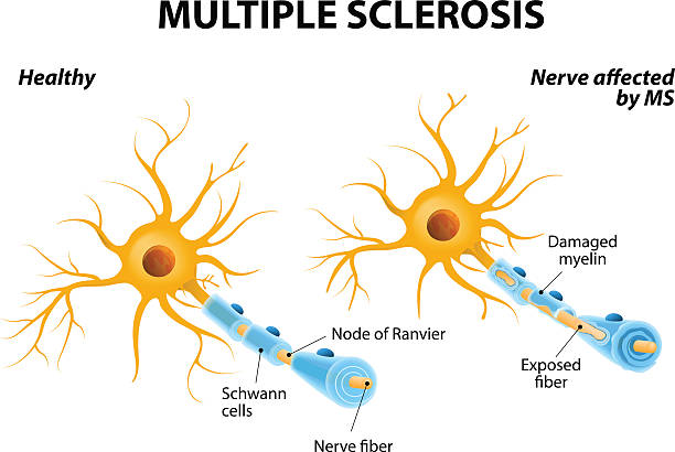 Multiple Sclerosis Multiple sclerosis or MS. autoimmune disease. the nerves of the brain and spinal cord are damaged by one's own immune system. resulting in loss of muscle control, vision and balance. medulla stock illustrations