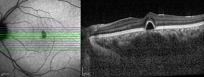 Optical Coherence Tomography . ( OCT )