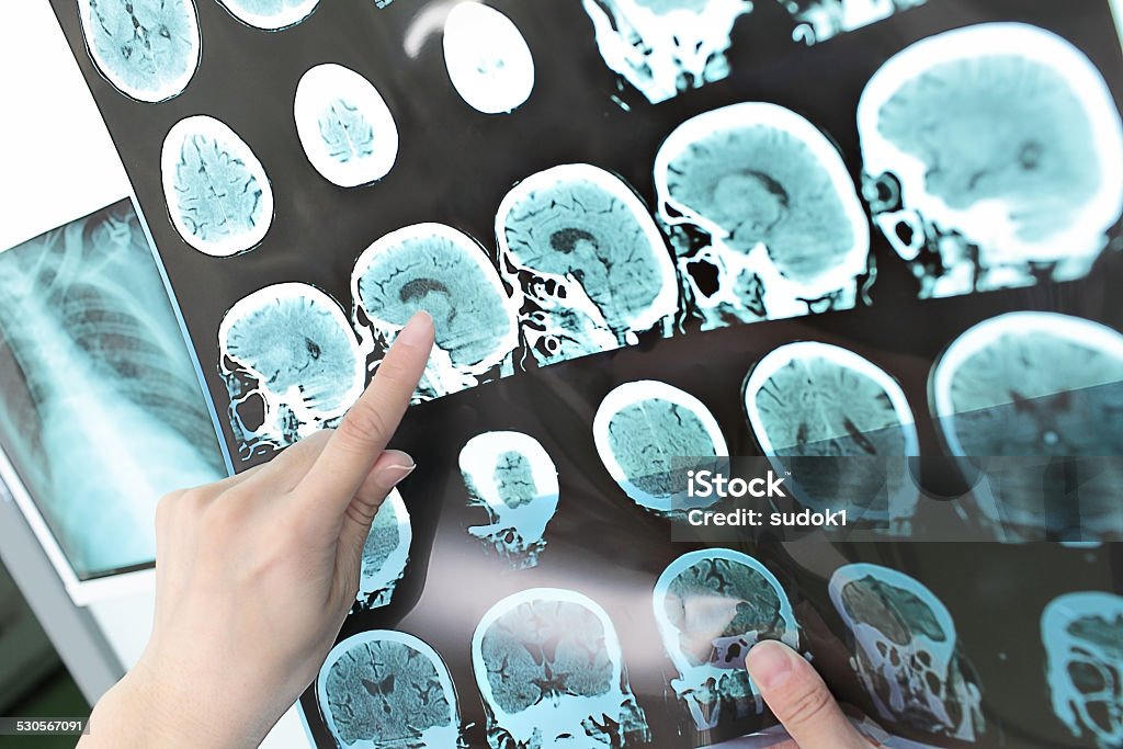 doctor view output CT scan. Multiple Sclerosis Stock Photo