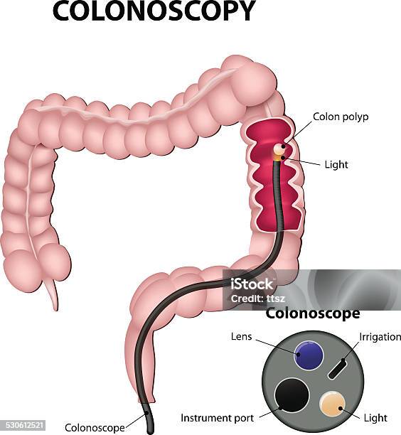 Colonoscopy Stock Vektor Art und mehr Bilder von Darmspiegelung - Darmspiegelung, Dickdarm - Verdauungstrakt, Endoskop