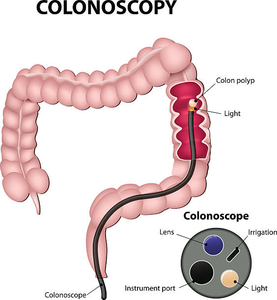 colonoscopy colonoscope in the colon. detail of the colonoscope colonoscopy stock illustrations