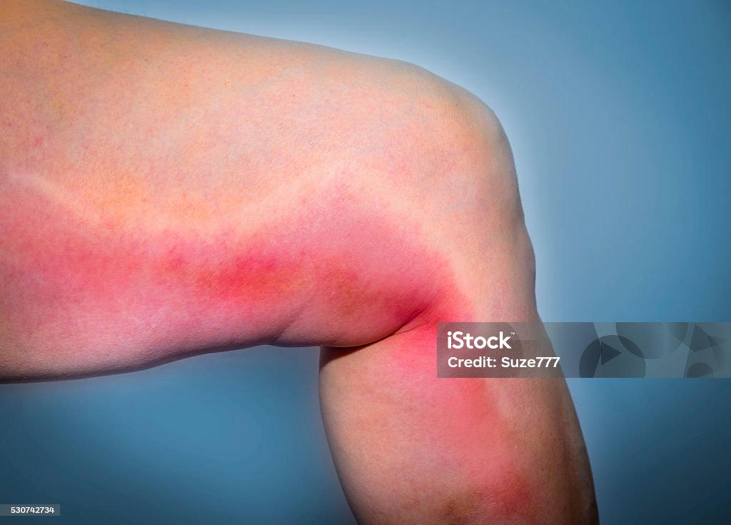 Thrombophlebitis in human leg Thrombophlebitis in human leg. Painful inflamation of the leg veins. Medical issue Blood Clot Stock Photo