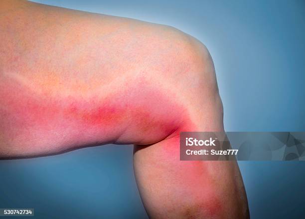 Thrombophlebitis In Human Leg Stock Photo - Download Image Now - Blood Clot, Chronic Illness, Edema
