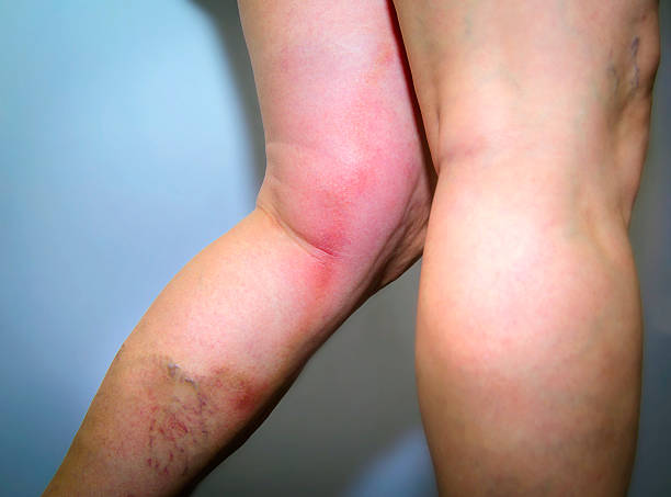 Thrombophlebitis in human leg Thrombophlebitis in human leg. Painful inflamation of the leg veins. Medical issue blood clot photos stock pictures, royalty-free photos & images