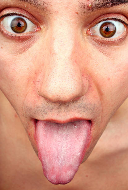 istock Herpes acne on the face 530863459