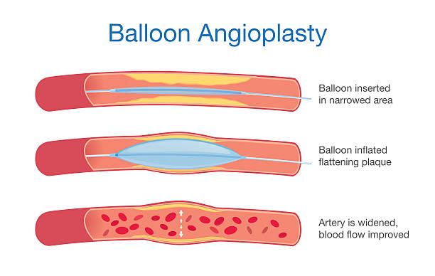 ilustraciones, imágenes clip art, dibujos animados e iconos de stock de angioplastia procedimiento globo - angioplasty